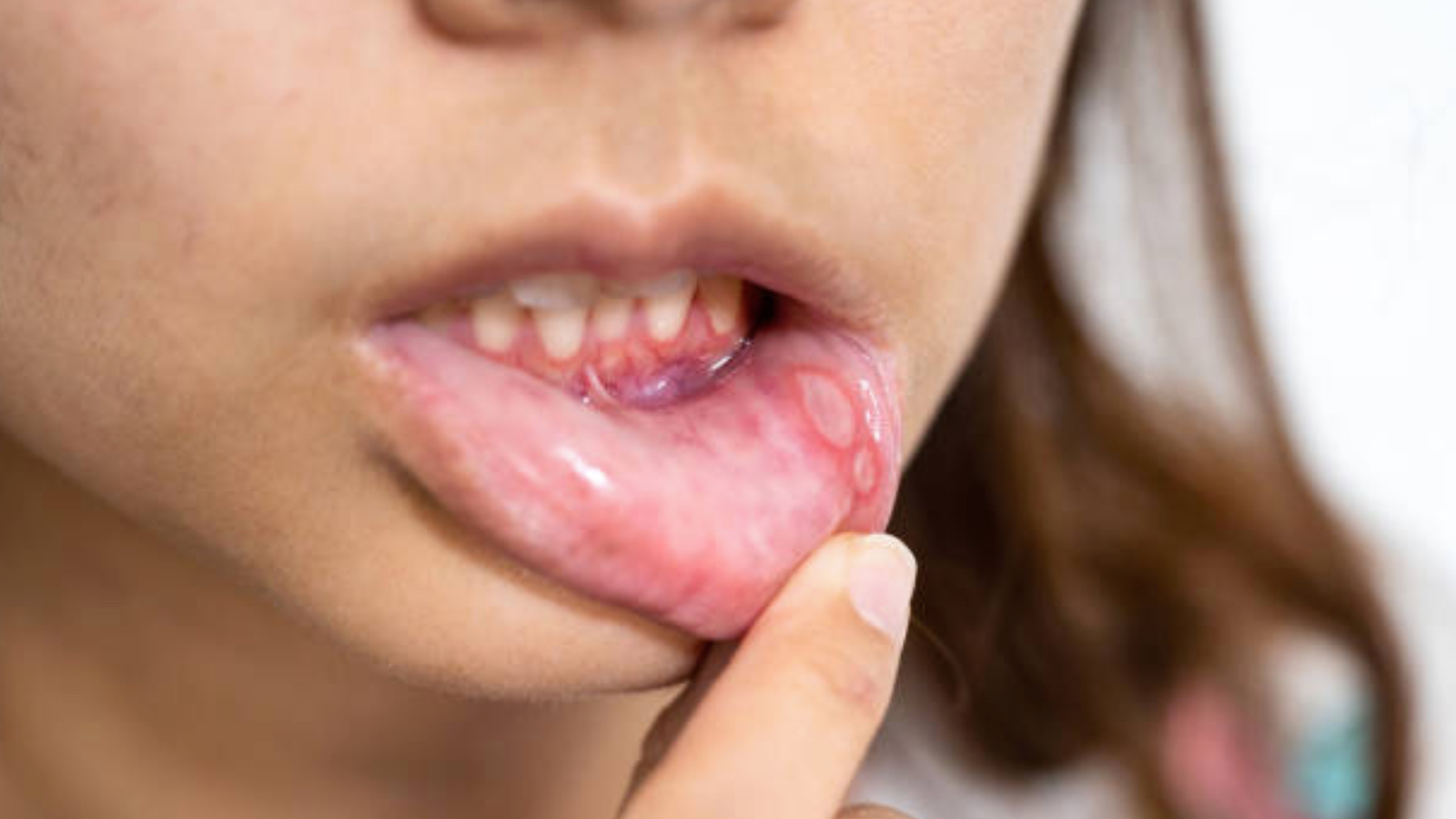 uzmani uyardi 2 haftadan uzun suren agiz yaralari ihmal edilmemeli OTg2IC3n